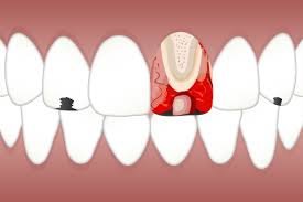 Tooth Bonding